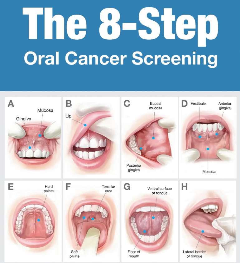 Oral Cancer Screenings Exton Family Dentist